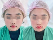 Làm đẹp - Cắt môi trái tim, gái xinh nhận về đôi môi như củ ấu, có ca còn như cửa không cánh