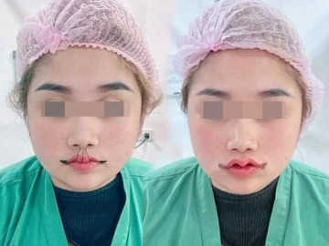 Cắt môi trái tim, gái xinh nhận về đôi môi như củ ấu, có ca còn như cửa không cánh