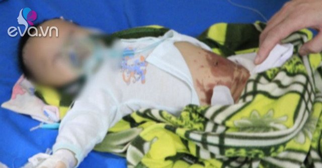 Newborn baby Phu Tho burns his stomach, in danger when he is covered with garlic to treat COVID-19