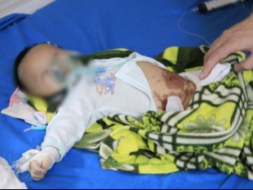 Bé sơ sinh Phú Thọ bỏng bụng, nguy kịch khi được đắp tỏi trị COVID-19