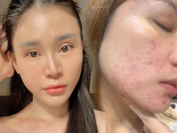 5 sản phẩm phải có khi dùng BHA để skincare