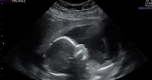 Wants to go to ultrasound to see baby's face, mother panics because her baby is threatened, she can't sleep at night - 2