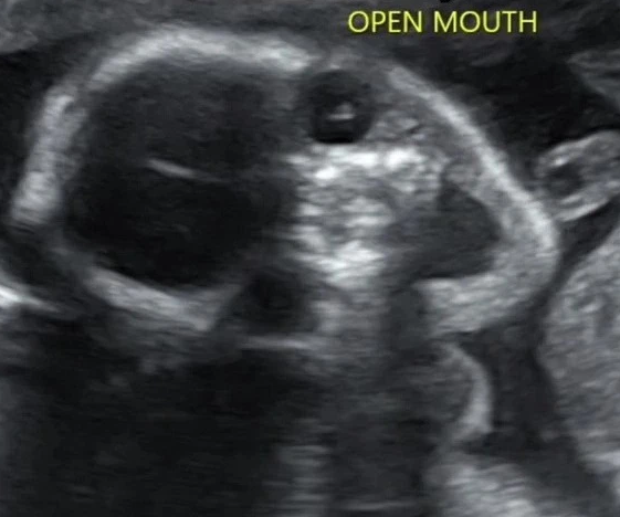 Wants to go to ultrasound to see baby's face, mother panics because her baby is threatened, she can't sleep at night - 3