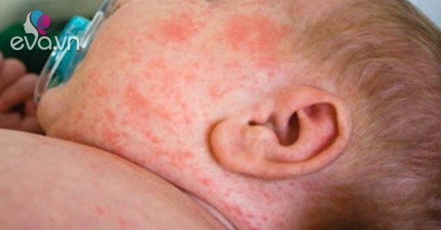 Children with COVID-19 with rashes is more of an encouraging sign than worrying