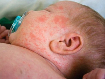 BS Trương Hữu Khanh: Trẻ mắc COVID-19 kèm phát ban là tín hiệu đáng mừng hơn đáng lo