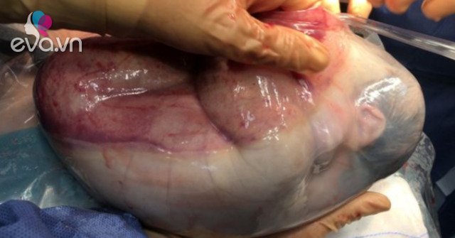 Rarely, twins are born when one baby is still in the amniotic sac, it takes a long time to come out