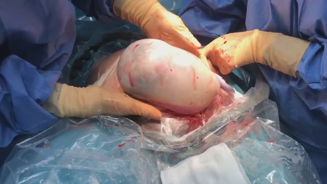 Rarely, twins are born when one baby is still in the amniotic sac, it takes a long time to come out - 1