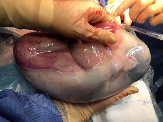 Rarely, twins are born when one baby is still in the amniotic sac, it takes a long time to come out - 3