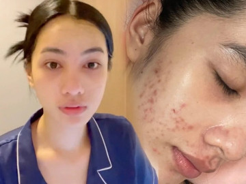 Ngày nào Cẩm Đan banh mặt vì mụn, giờ là mỹ nhân mặt mộc nhờ sửa sai đúng 1 điều