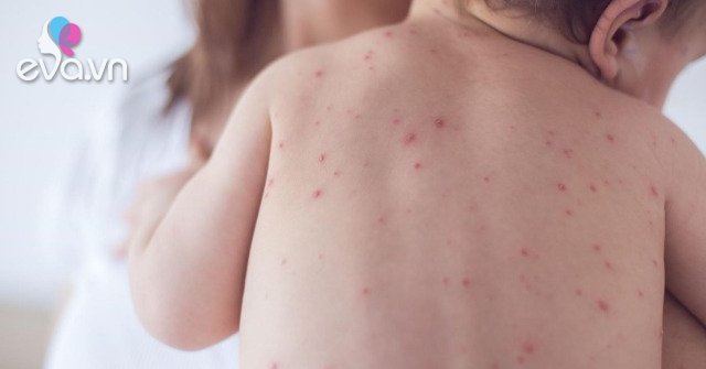 Chickenpox in children and their treatment