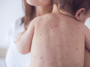 Bệnh thủy đậu ở trẻ em và cách chữa
