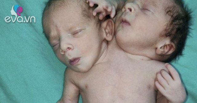Rare: Conjoined twins have 2 heads and 3 arms, doctors can’t operate yet