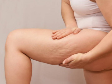 6 thực phẩm vạn người mê khiến da lồi lõm, sần vỏ cam vì mỡ tích chồng chất