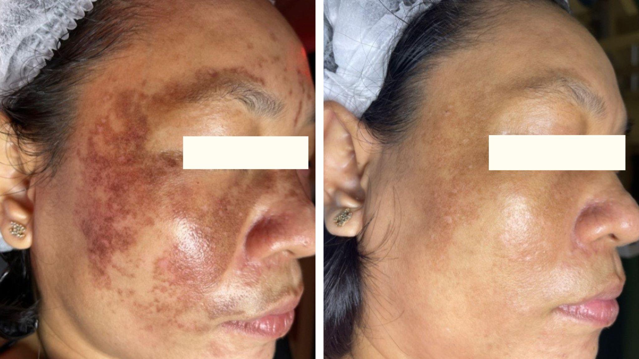 Một bệnh nhân điều trị nám biến chứng thành công tại DRH Clinic