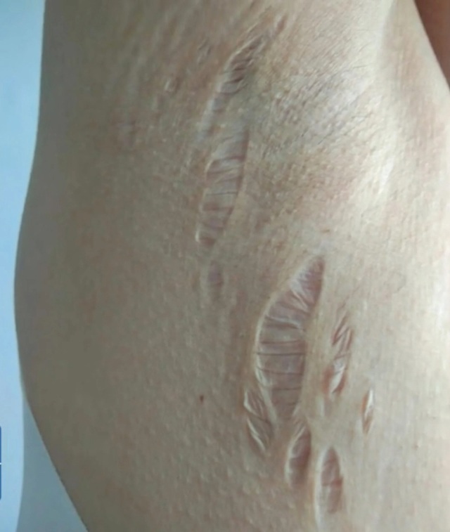 Những vết rạn và sẹo trên người cô Liu Chang