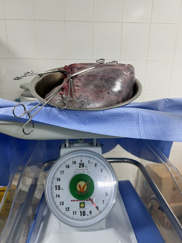 Sau khi mổ đẻ, các bác sĩ đã tiến hành cắt trọn khối u nang buồng trứng kích thước 70x50 cm, có cân nặng 8kg.