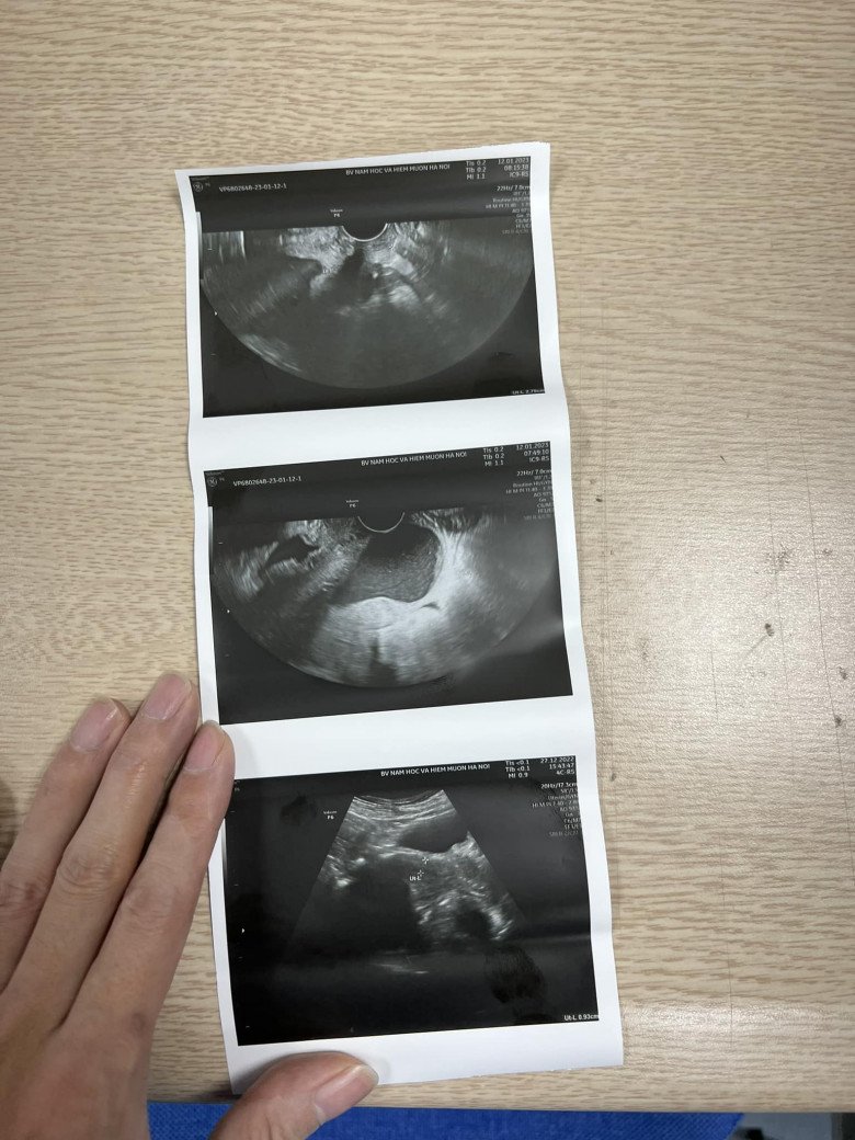 Khi sang tới viện, các sĩ trực siêu âm cho biết, cổ tử cung của chị Hà đo chỉ được 22mm nhưng đã mở 2cm, ối phồng bằng quả quýt. (Ảnh: BSCC)