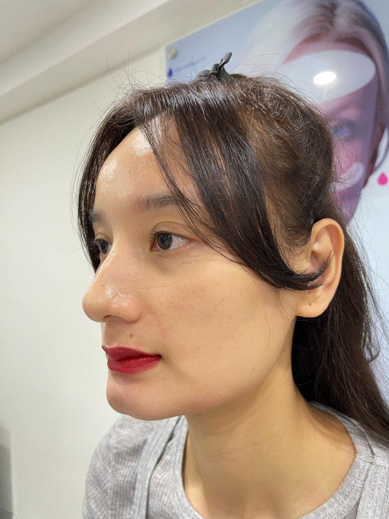Sau khi được tiêm, gương mặt Lê Thúy trông hài hòa hơn hẳn. Phần cằm dài hơn khiến cho phần nọng cằm trở nên gọn gàng, gương mặt thanh thoát và hút mắt hơn khá rõ.
