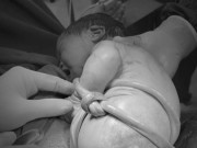 Bà bầu - Mổ đẻ thành công cho sản phụ 40 tuần với thai nhi bị dây rốn thắt nút, quấn quanh người