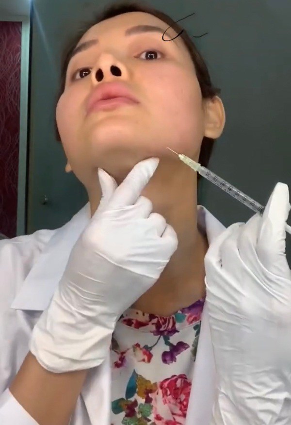 Chị em không nên tự tiêm filler vì chỉ cần lệch 1 chút là chất làm đầy có thể bị tiêm nhầm lan sang nơi khác, làm cho gương mặt trông như bị lệch, khó coi.