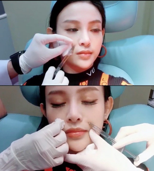 Phương pháp làm đẹp cấp tốc - tiêm filler được nhiều chị em và thậm chí là nhiều mỹ nhân trong showbiz ưa chuộng, mang đến cho chị em ngoại hình trẻ trung hơn.