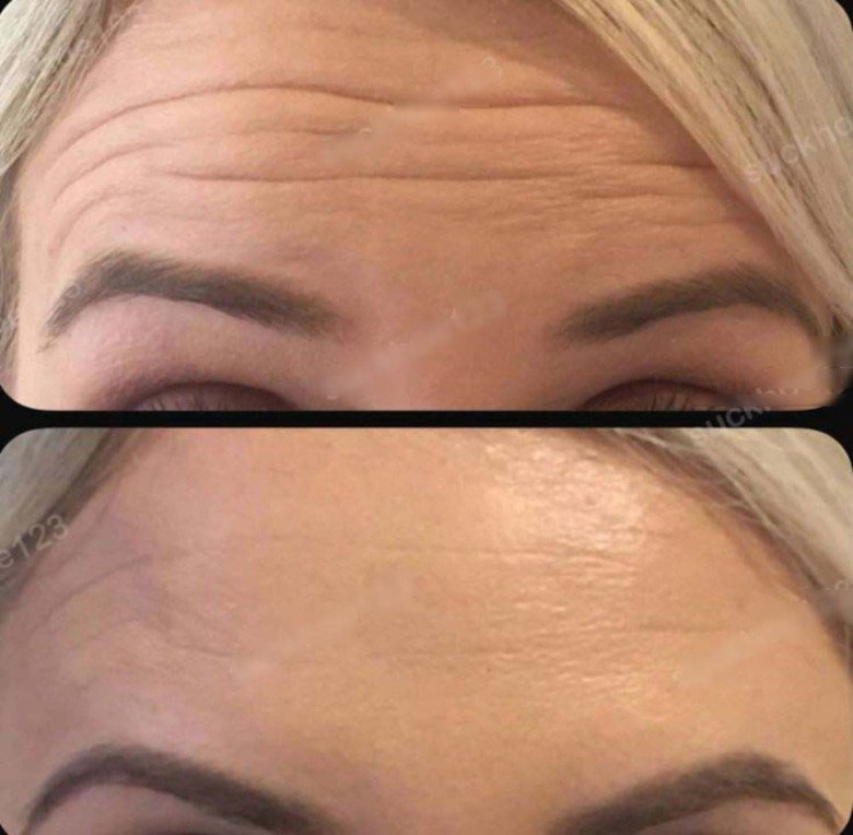 ​​​Khi tiêm filler, phần da của bạn sẽ được kéo căng. Và khi phần filler này tan đi, làn da nhăn nheo được kéo căng trước đó nay lại bị kéo giãn hơn và cuối cùng, khiến làn da nhăn nheo hơn. Điều này dẫn đến một hệ luỵ nữa đó chính là một khi đã tiêm filler, bạn phải duy trì tiêm filler liên tục.