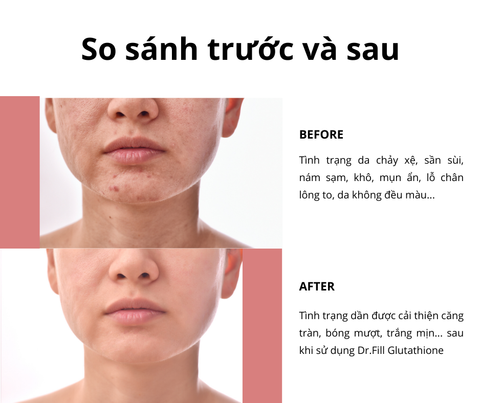 Film ngậm Glutathione
