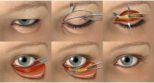 Cắt mí giọt lệ Trung Hoa là thủ thuật có xâm lấn, phải được thực hiện ở nơi có đủ điều kiện, được cấp phép. 