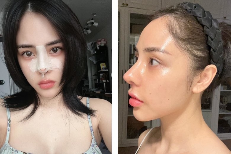 Bạn gái Huỳnh Anh quyết định chi trăm triệu để chỉnh lại chiếc mũi. Được biết, cô đã tháo bớt sụn mũi ra để trông hài hòa với gương mặt hơn.​​​​​​