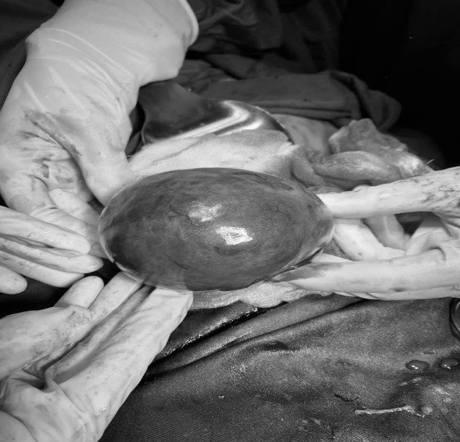 Hình ảnh khối u buồng trứng phải xuất huyết sau khi được bóc tách thành công. Ảnh: Sở Y tế tỉnh Phú Thọ.