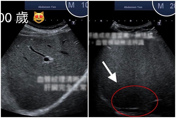 Hình ảnh siêu âm gan của cụ ông 100 tuổi (bên trái) trông sáng rõ còn gan của thanh niên 28 tuổi (bên phải) có một vùng tối do gan nhiễm mỡ. 