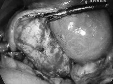 Thi thoảng đau bụng âm ỉ người phụ nữ bất ngờ phát hiện khối lạc nội mạc tử cung