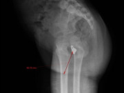 Sức khỏe - Bé gái Phú Thọ bị mắc kẹt chiếc nhẫn trong vùng kín, khi biết nguyên nhân ai cũng sốc