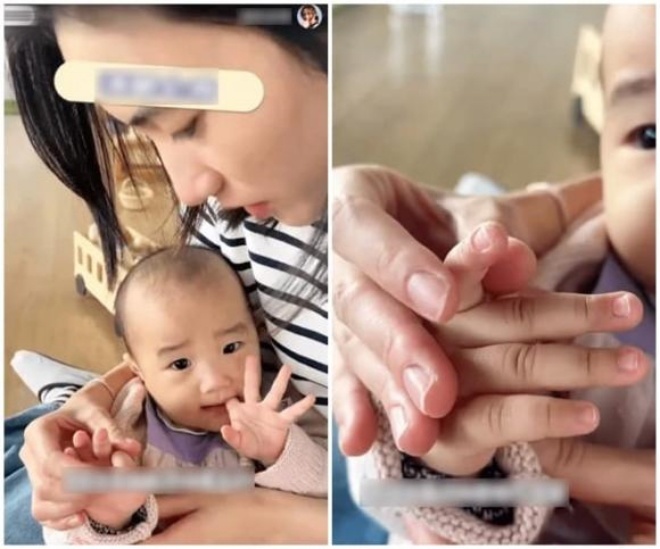 Lý Hạ từng gặp vấn đề về gen, ngón tay bị bong tróc nghiêm trọng. 