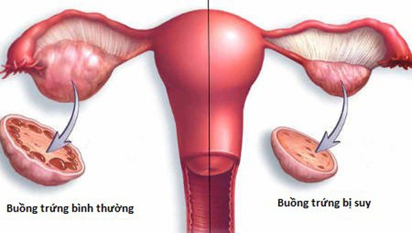 Suy buồng trứng là một trong những nguyên nhân gây vô sinh, hiếm muộn. 