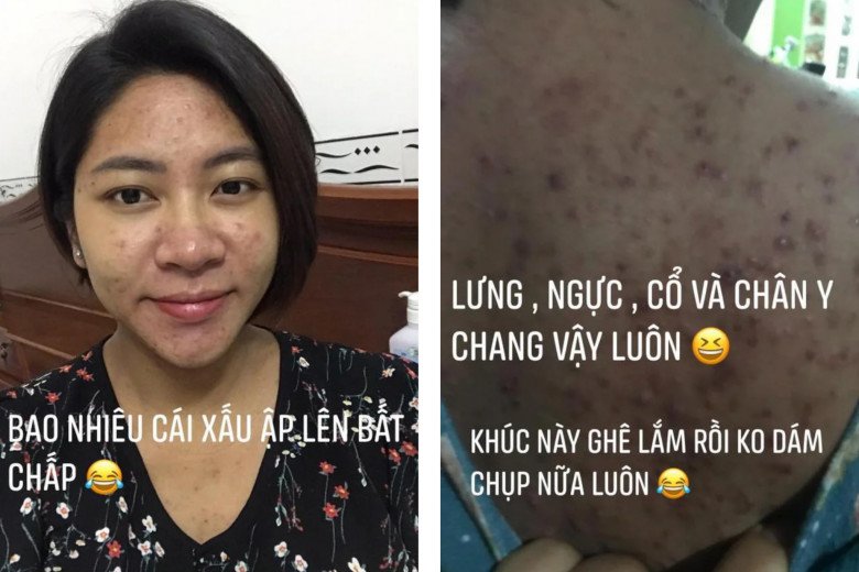 Đáng nói hơn cả, mặt và lưng của người đẹp có mụn chi chít đến mức sởn da gà, phần nào khiến làn da trở nên đen sạm.