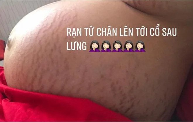 Từ một người đẹp với nhan sắc yêu kiều, nuột nà, Thu Thảo tăng cân vùn vụt khi mang thai. Phần da bụng rạn đỏ chằng chịt, các đường nét cơ thể bị phá nét.