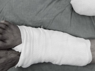 Chuyện chưa kể về bác sĩ nuôi chân chờ nối chi đứt rời cho bệnh nhân