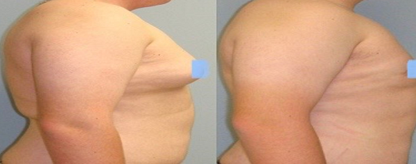 Nam giới trưởng thành bị phì đại tuyến vú cần phải can thiệp và xử lý. Ảnh: BSCC.