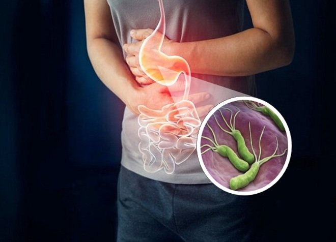 Nhiều nghiên cứu ở Nhật Bản đã xác định nhiễm vi khuẩn H. pylori là một yếu tố nguy cơ quan trọng gây ung thư dạ dày. (Ảnh minh họa)