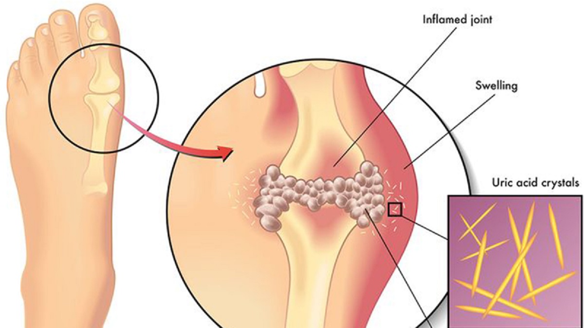 10 Loại thực phẩm là “khắc tinh” của bệnh gout, ăn thường xuyên không lo bệnh tái phát - 1