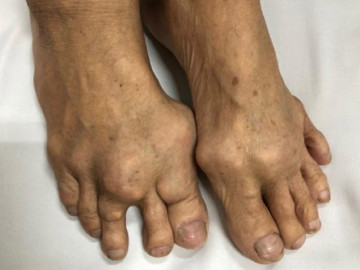 10 Loại thực phẩm là “khắc tinh” của bệnh gout, ăn thường xuyên không lo bệnh tái phát