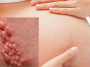 Bà bầu - Bệnh lậu ảnh hưởng đến thai nhi thế nào?