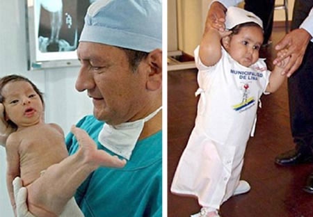 Nàng tiên cá bé nhỏ người Peru đã tự đứng và đi vịn sau ca phẫu thuật thứ hai lúc 2 tuổi.