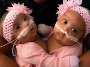 Bà bầu - Cực hiếm: Cặp song sinh dính liền có chung lá gan, sau sinh trải qua ca phẫu thuật nghẹt thở