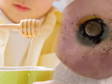 Tại sao mật ong có thể cứu sống trẻ nếu nuốt phải pin cúc áo? Đoạn video của nhân viên y tế tiết lộ sự thật