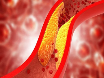 12 loại thực phẩm tốt cho người bị cholesterol cao không nên bỏ qua
