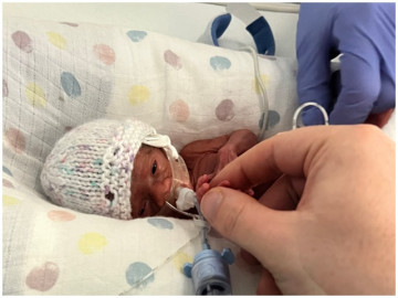 Kỳ tích: Em bé chào đời chỉ 400 gram thoát khỏi lưỡi hái tử thần, phát triển khỏe mạnh