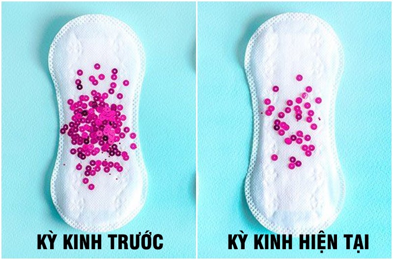 Nếu lượng máu kinh của bạn đột nhiên giảm đáng kể so với lần trước, kèm theo các triệu chứng như đau bụng dưới, khó chịu thì đó có thể do tắc nghẽn máu.
