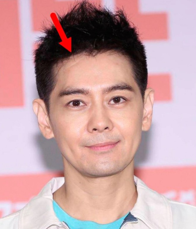 Trên mặt của Lâm Chí Dĩnh có dấu tích vết lõm. 